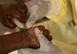 WHO declares mpox, caused by monkeypox virus, a global emergency: What you need to know – USA TODAY