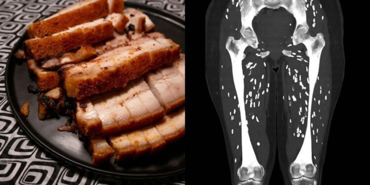 'One Of The Craziest CT Scans': US Doctor Reveals Disturbing Effects Of Undercooked Pork On Body