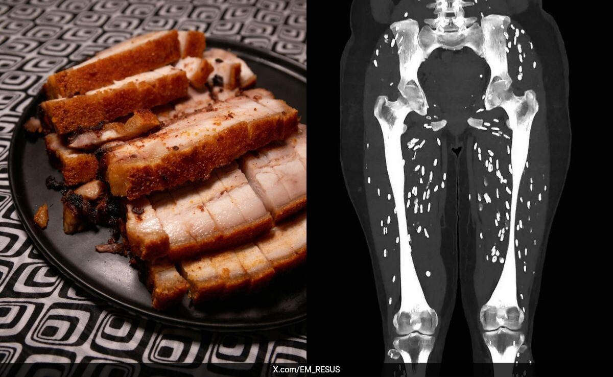 'One Of The Craziest CT Scans': US Doctor Reveals Disturbing Effects Of Undercooked Pork On Body